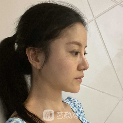 北京301医院削骨磨腮实例展示|内含亲身体验实例