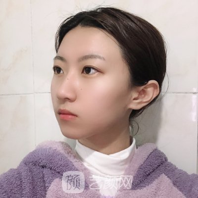 第四军医大学美容整形科怎么样?瘦脸针一周变化图展示