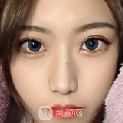 第四军医大学美容整形科怎么样?瘦脸针一周变化图展示