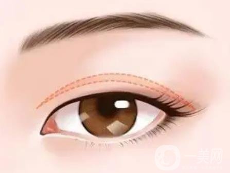 全切双眼皮韩式双眼皮有哪些不同?