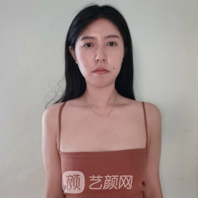 绍兴维美整形医院自体脂肪隆胸案例公开｜附效果图