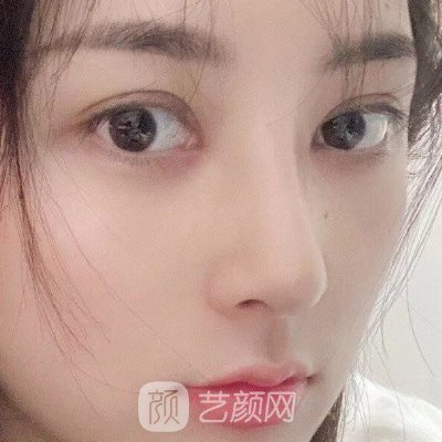 南京友谊金柱翰做鼻子怎么样?全新体验案例公开