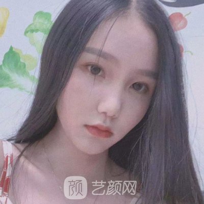 北京艺美整形医院吸脂瘦脸案例公开|效果自然美观