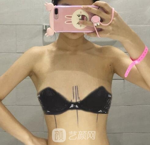 西京医院易成刚奥美定取出技术如何？医生简介+实例对比图