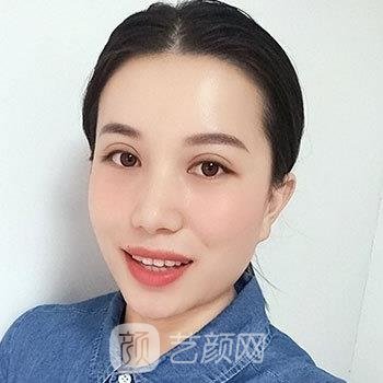 双眼皮手术恢复期图，术后一个月超美蝶变体验真实案例分享