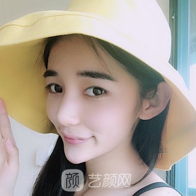 付俊俐做双眼皮怎么样?医生招牌实例公布
