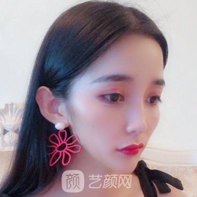 付俊俐做双眼皮怎么样?医生招牌实例公布