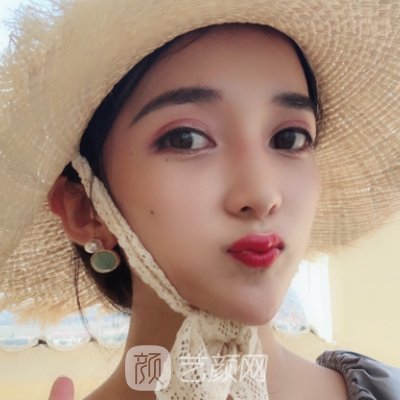 付俊俐做双眼皮怎么样?医生招牌实例公布