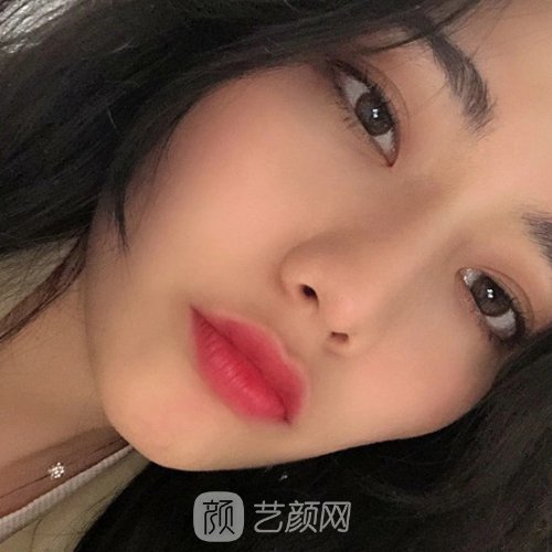北京何照华做颧骨怎么样？2022全新实例发布