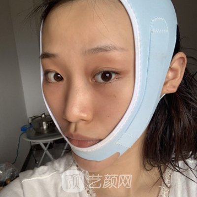广西医科大一附院整形科瘦脸实例展示｜前后对比成果让人惊讶
