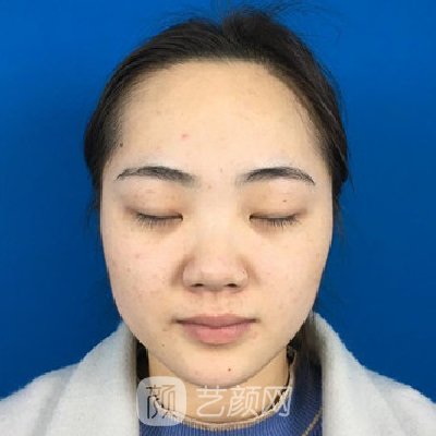青医附院匡瑞霞割双眼皮技术怎么样？全新体验实例公开