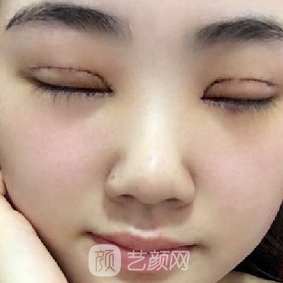 青医附院匡瑞霞割双眼皮技术怎么样？全新体验实例公开
