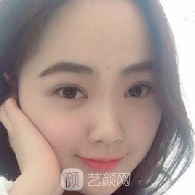 青医附院匡瑞霞割双眼皮技术怎么样？全新体验实例公开