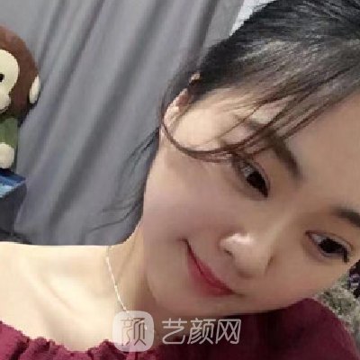青医附院匡瑞霞割双眼皮技术怎么样？全新体验实例公开