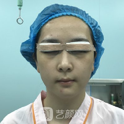 郑州集美做双眼皮怎么样？医院招牌实例曝光