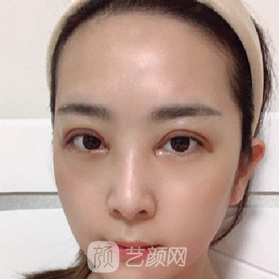 郑州集美做双眼皮怎么样？医院招牌实例曝光