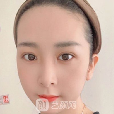 郑州集美做双眼皮怎么样？医院招牌实例曝光