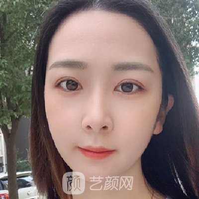 郑州集美做双眼皮怎么样？医院招牌实例曝光