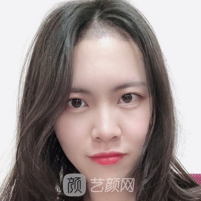 湘雅二医院植发价格表公开｜官网收费标准及实例展示