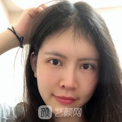 湘雅二医院植发价格表公开｜官网收费标准及实例展示