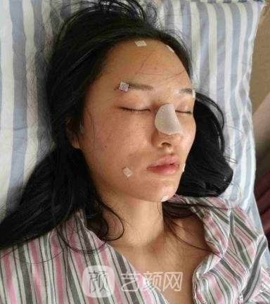 孟强隆鼻实例，鼻部整形手术修复全过程一览