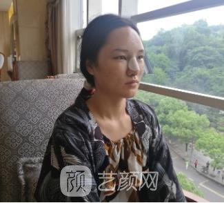 孟强隆鼻实例，鼻部整形手术修复全过程一览