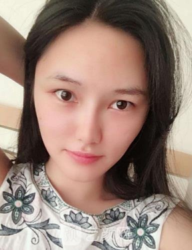 孟强隆鼻实例，鼻部整形手术修复全过程一览