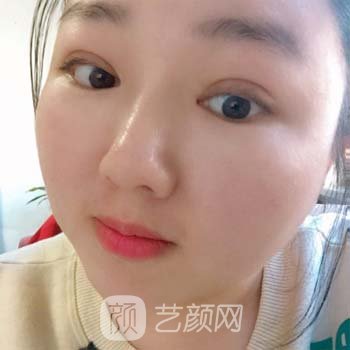 长沙爱思特张姣姣医生做提眉手术怎么样？真人实例鉴赏