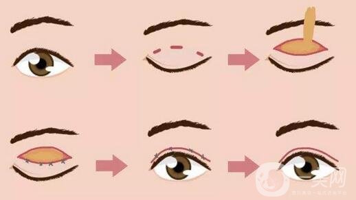 北京埋线双眼皮修复价格盘点