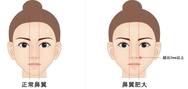 不对称的鼻翼矫正的成果好不好?