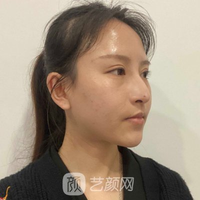 广东美恩张勇做鼻子风格公开|内附真人体验感悟