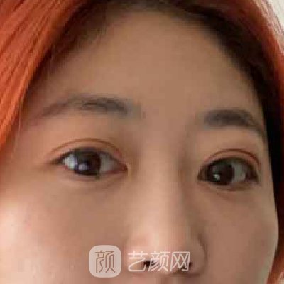重庆华美杨丽萍祛眼袋怎么样?全新体验实例公布