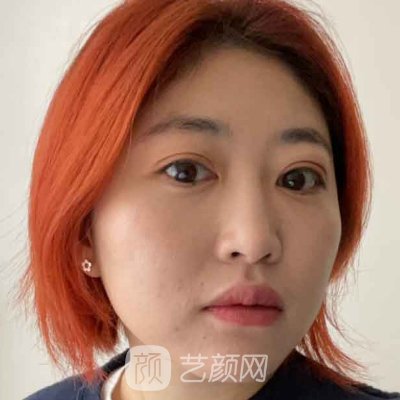 重庆华美杨丽萍祛眼袋怎么样?全新体验实例公布