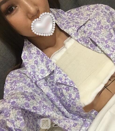 上海华美谢卫国隆胸实例，身材凹凸有致，魅力大增