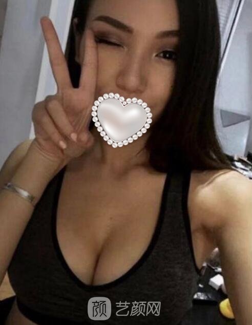 上海华美谢卫国隆胸实例，身材凹凸有致，魅力大增