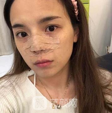 合肥杜晓杨怎么没有实例？医生简介+肋软骨隆鼻实例
