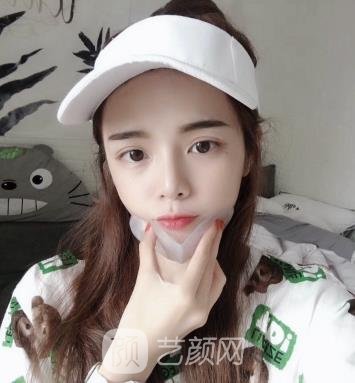 合肥杜晓杨怎么没有实例？医生简介+肋软骨隆鼻实例