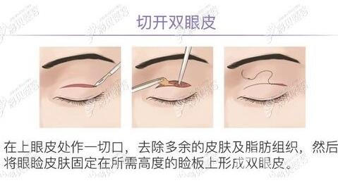 淮安整形医院排行榜前三权威发布！苏美尔、华美口碑实力在线_附双眼皮实例推荐