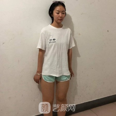 兰州韩美整形医院大腿抽脂效果怎么样?亲身体验效果图出炉