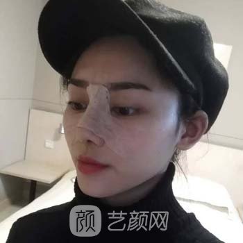 北京八大处隆鼻案例，手术前后对比照片分享