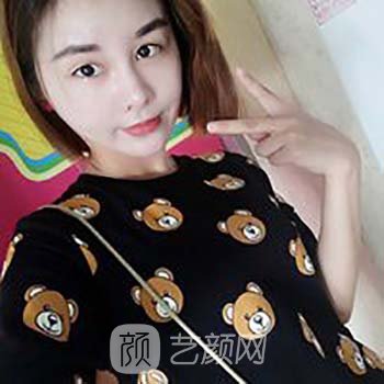 面部脂肪填充修复过程图片，30天后成果图美到爆