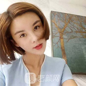 面部脂肪填充修复过程图片，30天后成果图美到爆
