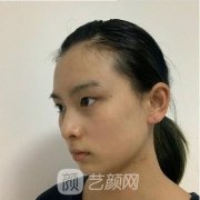 北京医院赵红艺双眼皮实例，全切双眼皮做完眼睛又大又闪亮