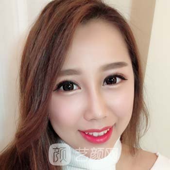 北京八大处祁佐良隆鼻实例，面部看起来更有层次感，打造自然的妈生鼻