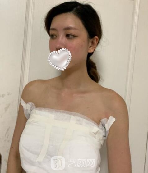 华美李健隆胸手术实例，术后胸部的手感很柔软自然