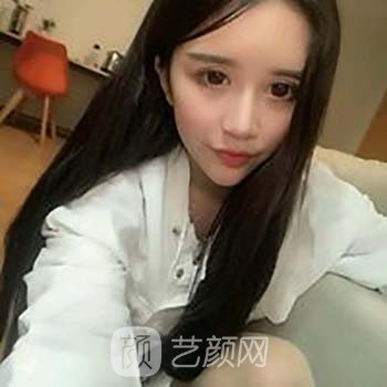 田永成tbm面部提升怎么样？价格是多少钱？附真人实例