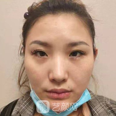 重庆美仑美奂王金花医生怎么样?医生实力及双眼皮实例发布