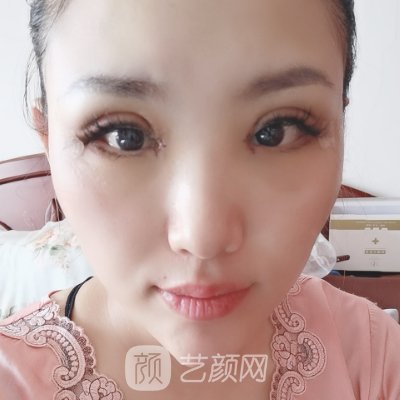 重庆美仑美奂王金花医生怎么样?医生实力及双眼皮实例发布