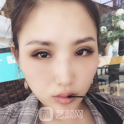 重庆美仑美奂王金花医生怎么样?医生实力及双眼皮实例发布