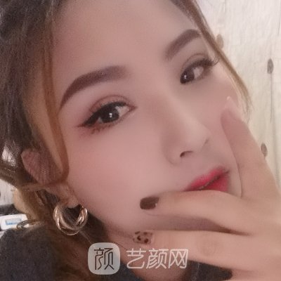 重庆美仑美奂王金花医生怎么样?医生实力及双眼皮实例发布